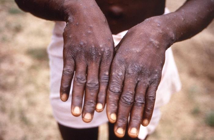 monkeypox bayelsa