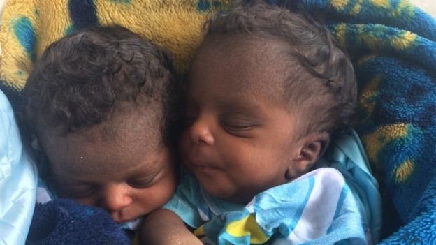 Mother of twins loses access to baby over hospital bills
