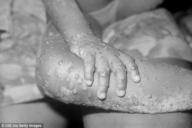 Monkeypox has been discovered in the UK for the first time ever after a naval officer contracted it in Nigeria