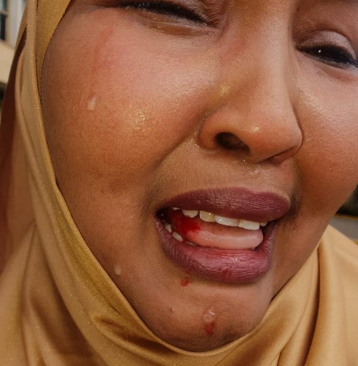 Kenyan Female MP, Fatuma Gedi after she was beaten up by a colleague, Rashid Kassim