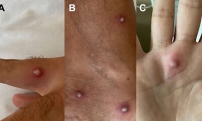 Man tests positive for monkeypox, COVID and HIV after holiday to Spain A 36-year-old patient in Italy returned from holiday in Spain and later presented with a series of symptoms that led doctors to carry out a series of tests. They found he was the first patient so far discovered to have COVID, monkeypox and HIV. Philip Whiteside News reporter Thursday 25 August 2022 13:36, UK Large spots on the body of a man who was found to be suffering from monkeypox. Pic: Journal of Infection Image: Large spots on the body of a man who was found to be suffering from monkeypox