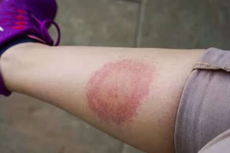 Lyme Disease: All you need to know about disease affecting 1,500 in UK